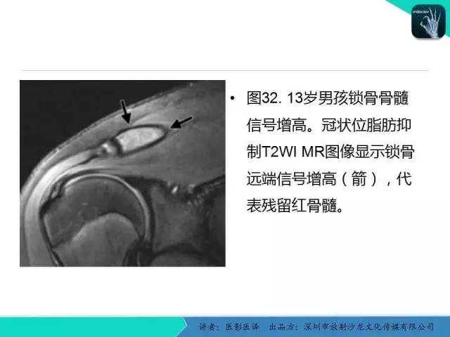 【PPT】儿童肩关节正常骨骼发育和影像诊断陷阱