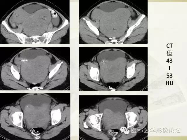 【病例】卵巢纤维卵泡膜细胞瘤1例CT影像表现 【病例】卵巢纤维卵泡膜细胞瘤1例CT影像表现