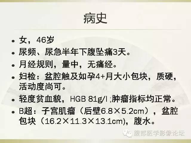 【病例】卵巢纤维卵泡膜细胞瘤1例CT影像表现