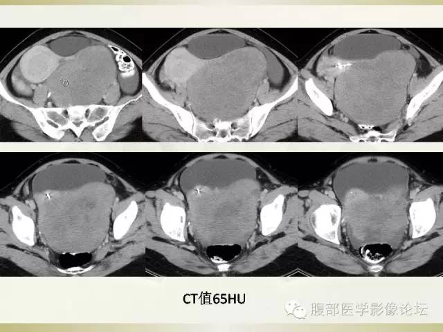 【病例】卵巢纤维卵泡膜细胞瘤1例CT影像表现 【病例】卵巢纤维卵泡膜细胞瘤1例CT影像表现