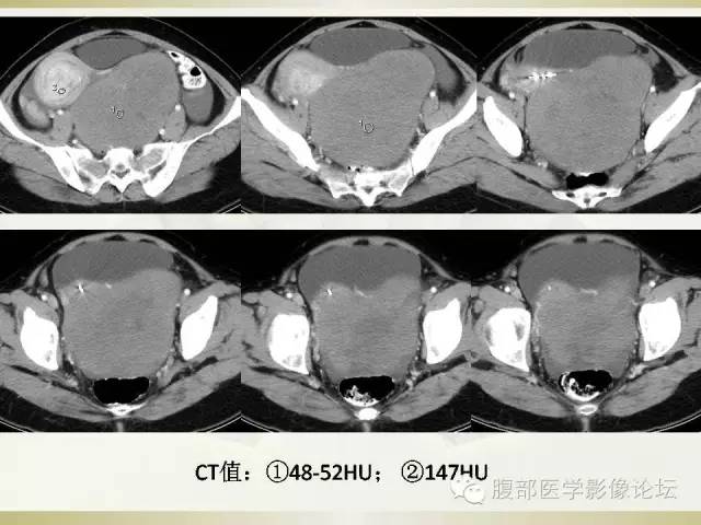 【病例】卵巢纤维卵泡膜细胞瘤1例CT影像表现 【病例】卵巢纤维卵泡膜细胞瘤1例CT影像表现