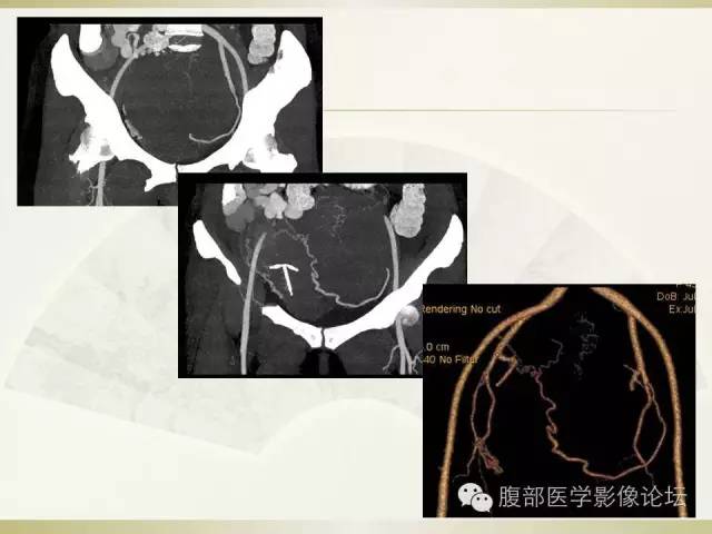 【病例】卵巢纤维卵泡膜细胞瘤1例CT影像表现 【病例】卵巢纤维卵泡膜细胞瘤1例CT影像表现