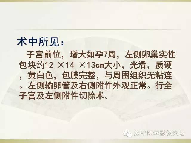 【病例】卵巢纤维卵泡膜细胞瘤1例CT影像表现 【病例】卵巢纤维卵泡膜细胞瘤1例CT影像表现