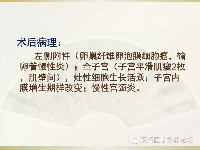 【病例】卵巢纤维卵泡膜细胞瘤1例CT影像表现 【病例】卵巢纤维卵泡膜细胞瘤1例CT影像表现