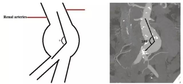 轻松掌握腹主动脉瘤 CTA 评估要点 轻松掌握腹主动脉瘤 CTA 评估要点