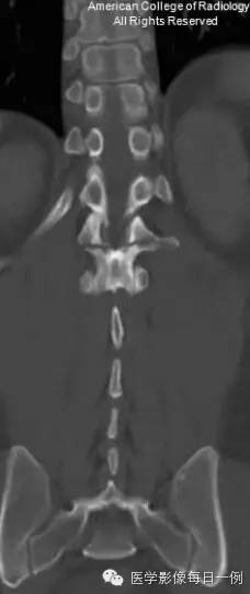 【病例】腰椎Chance骨折1例CT及MR影像表现 【病例】腰椎Chance骨折1例CT及MR影像表现