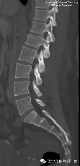 【病例】腰椎Chance骨折1例CT及MR影像表现 【病例】腰椎Chance骨折1例CT及MR影像表现