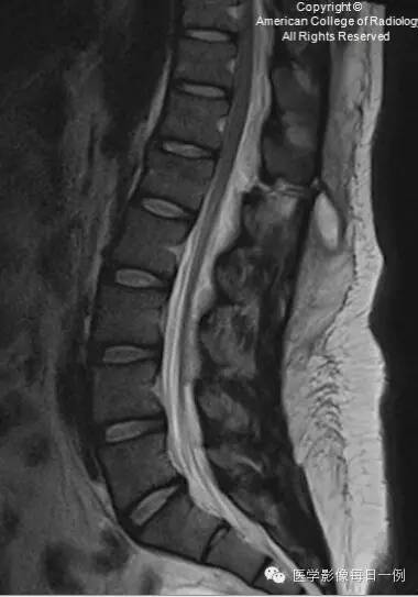 【病例】腰椎Chance骨折1例CT及MR影像表现 【病例】腰椎Chance骨折1例CT及MR影像表现