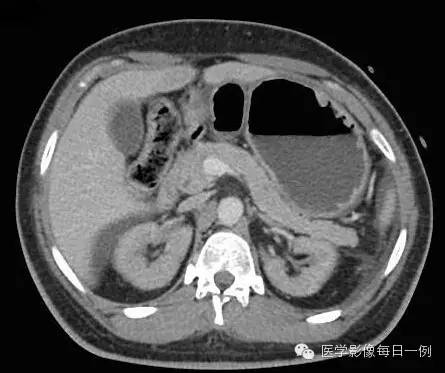 【病例】腰椎Chance骨折1例CT及MR影像表现 【病例】腰椎Chance骨折1例CT及MR影像表现