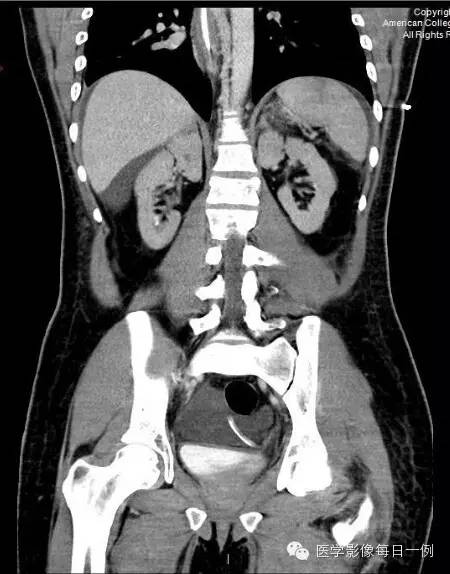 【病例】腰椎Chance骨折1例CT及MR影像表现 【病例】腰椎Chance骨折1例CT及MR影像表现