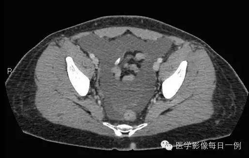 【病例】腰椎Chance骨折1例CT及MR影像表现 【病例】腰椎Chance骨折1例CT及MR影像表现