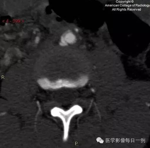 【病例】腰椎Chance骨折1例CT及MR影像表现