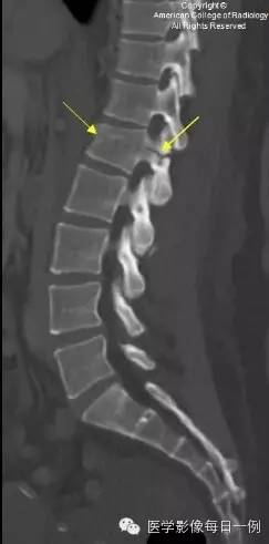 【病例】腰椎Chance骨折1例CT及MR影像表现 【病例】腰椎Chance骨折1例CT及MR影像表现