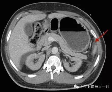 【病例】腰椎Chance骨折1例CT及MR影像表现 【病例】腰椎Chance骨折1例CT及MR影像表现