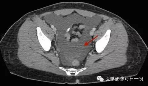 【病例】腰椎Chance骨折1例CT及MR影像表现 【病例】腰椎Chance骨折1例CT及MR影像表现