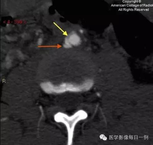 【病例】腰椎Chance骨折1例CT及MR影像表现 【病例】腰椎Chance骨折1例CT及MR影像表现
