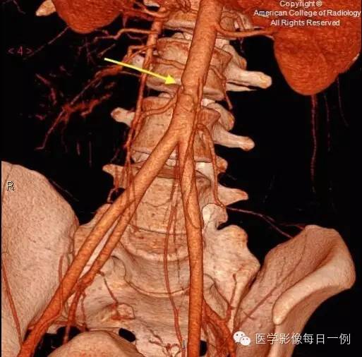 【病例】腰椎Chance骨折1例CT及MR影像表现 【病例】腰椎Chance骨折1例CT及MR影像表现