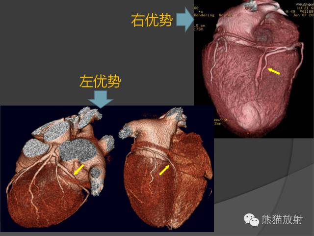 【PPT】冠状动脉的优势判断、起源异常及心肌桥