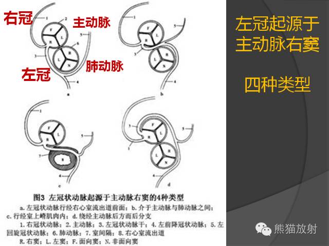 【PPT】冠状动脉的优势判断、起源异常及心肌桥