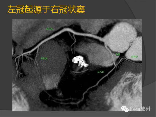 【PPT】冠状动脉的优势判断、起源异常及心肌桥