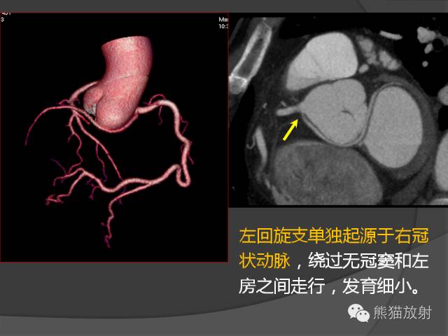【PPT】冠状动脉的优势判断、起源异常及心肌桥