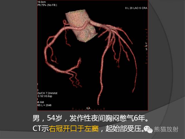 【PPT】冠状动脉的优势判断、起源异常及心肌桥