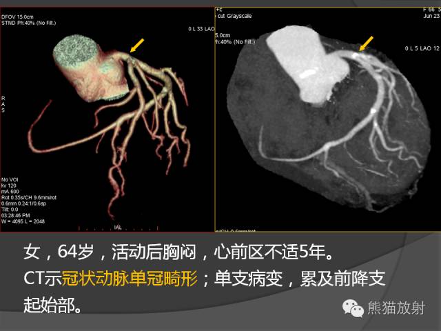 【PPT】冠状动脉的优势判断、起源异常及心肌桥