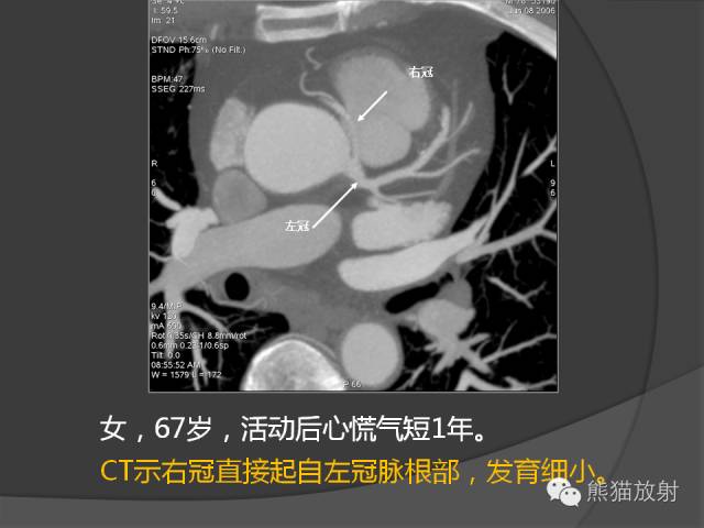 【PPT】冠状动脉的优势判断、起源异常及心肌桥