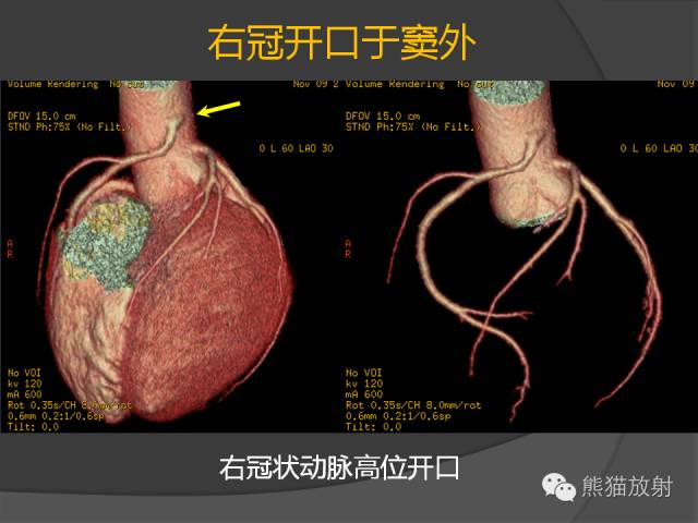 【PPT】冠状动脉的优势判断、起源异常及心肌桥