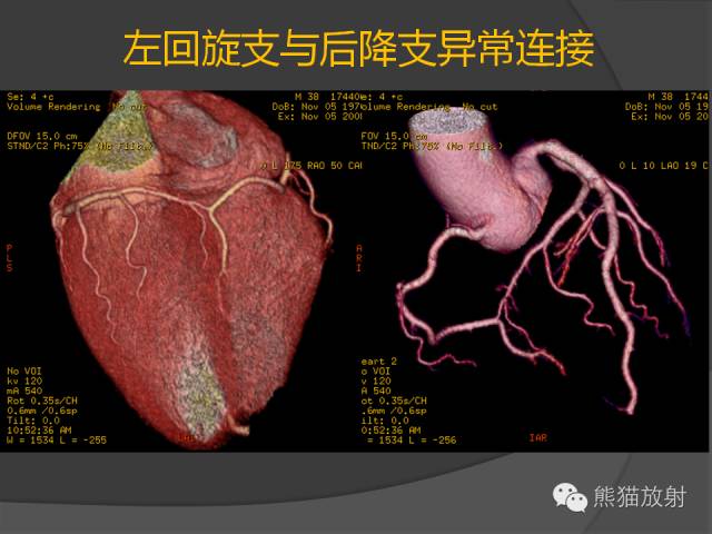 【PPT】冠状动脉的优势判断、起源异常及心肌桥