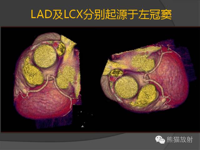 【PPT】冠状动脉的优势判断、起源异常及心肌桥