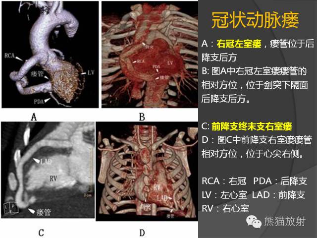 【PPT】冠状动脉的优势判断、起源异常及心肌桥