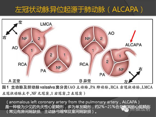【PPT】冠状动脉的优势判断、起源异常及心肌桥