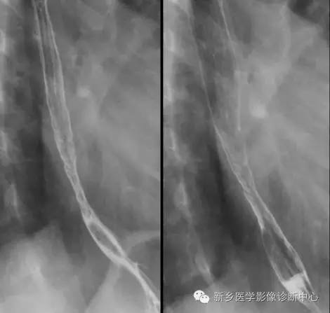 反流性食管炎/消化性食管炎 反流性食管炎/消化性食管炎