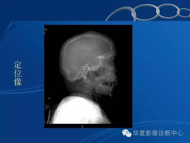 【PPT】骨纤维异常增殖症——骨性狮面