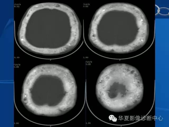 【PPT】骨纤维异常增殖症——骨性狮面