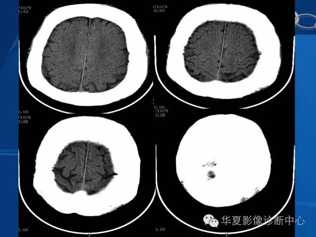 【PPT】骨纤维异常增殖症——骨性狮面