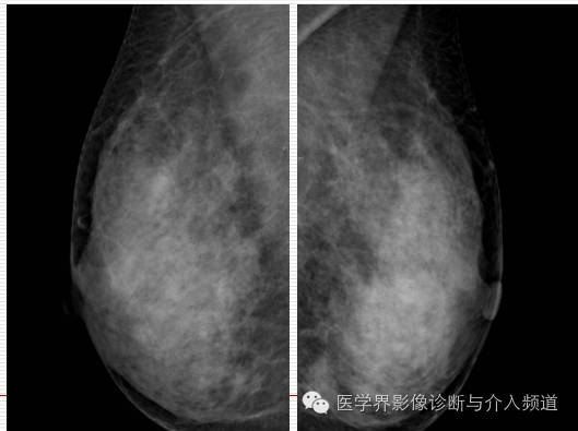 乳腺增生X线分类，你掌握了吗？