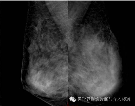 乳腺增生X线分类,你掌握了吗? 乳腺增生X线分类,你掌握了吗?