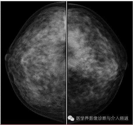 乳腺增生X线分类,你掌握了吗? 乳腺增生X线分类,你掌握了吗?