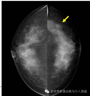 乳腺增生X线分类,你掌握了吗? 乳腺增生X线分类,你掌握了吗?
