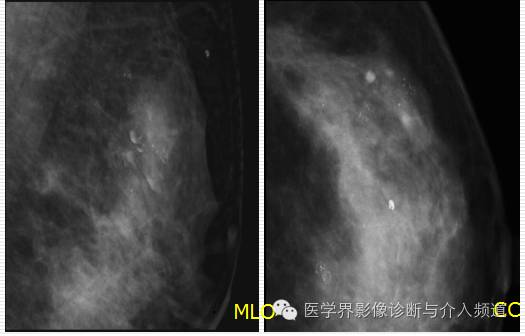 乳腺增生X线分类,你掌握了吗? 乳腺增生X线分类,你掌握了吗?