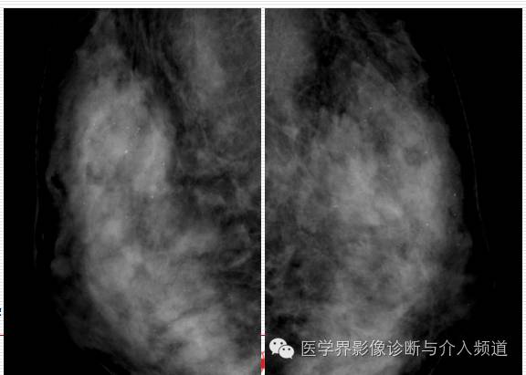乳腺增生X线分类,你掌握了吗? 乳腺增生X线分类,你掌握了吗?