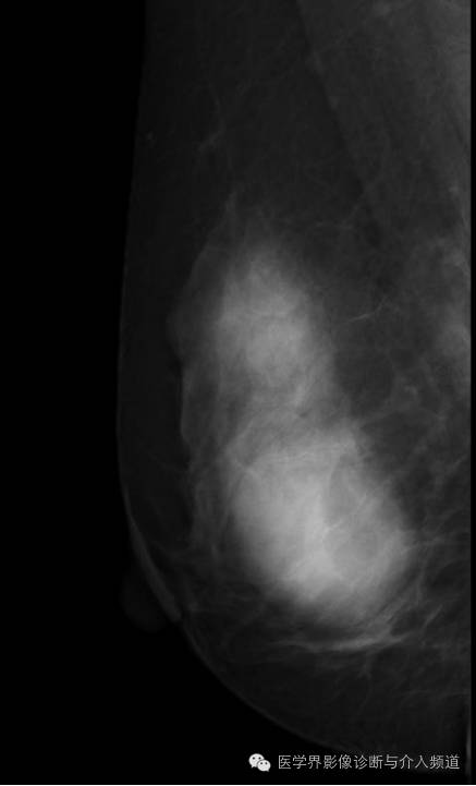 乳腺增生X线分类,你掌握了吗? 乳腺增生X线分类,你掌握了吗?