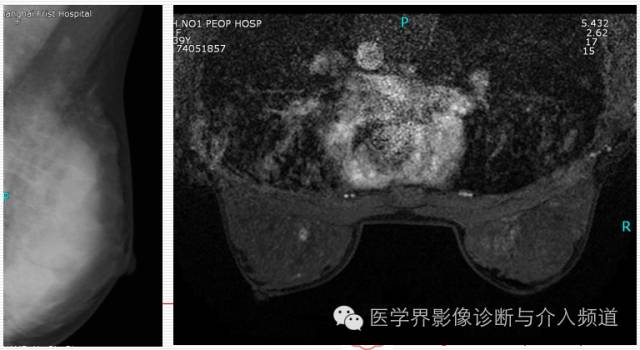 乳腺增生X线分类,你掌握了吗? 乳腺增生X线分类,你掌握了吗?