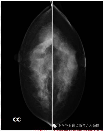 乳腺增生X线分类,你掌握了吗? 乳腺增生X线分类,你掌握了吗?