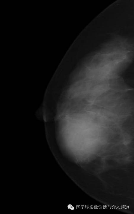 乳腺增生X线分类,你掌握了吗? 乳腺增生X线分类,你掌握了吗?