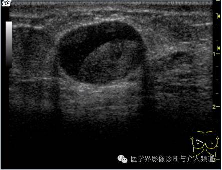 乳腺增生X线分类,你掌握了吗? 乳腺增生X线分类,你掌握了吗?
