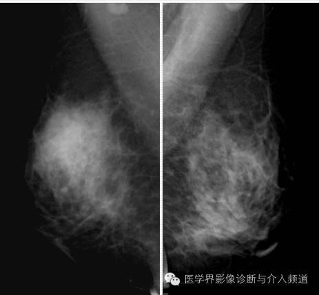 乳腺增生X线分类,你掌握了吗? 乳腺增生X线分类,你掌握了吗?