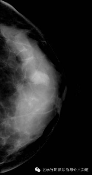 乳腺增生X线分类,你掌握了吗? 乳腺增生X线分类,你掌握了吗?